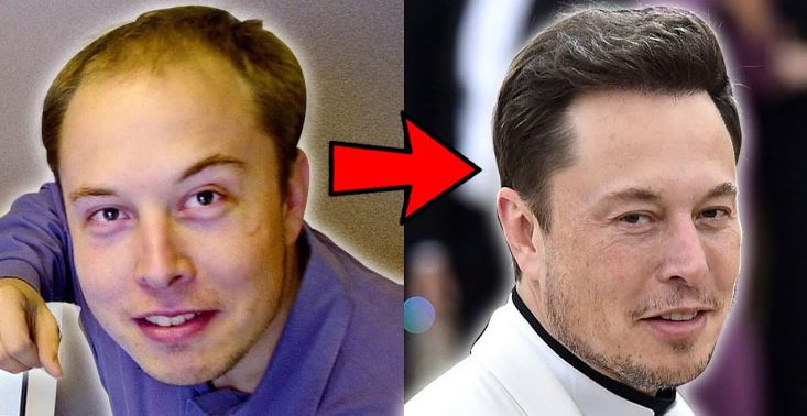 Elon Musk Hair Transplant: how he Reversed his Hair Loss - Techie + Gamers